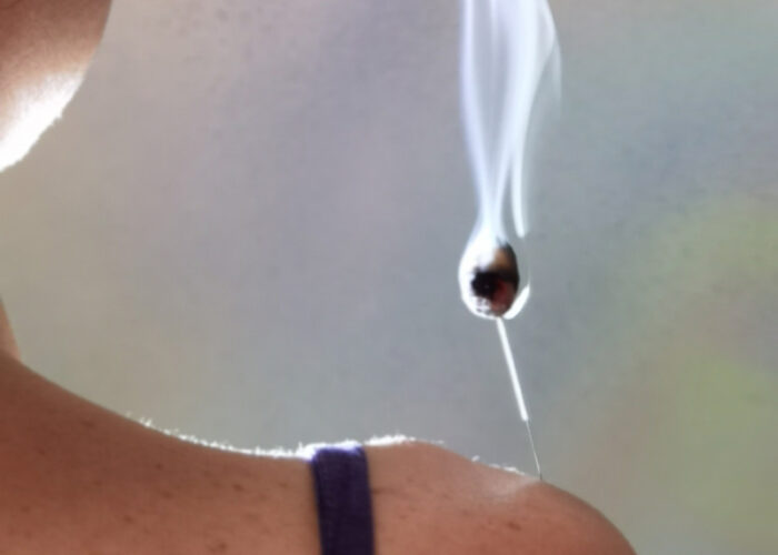 Servicio acupuntura y moxibustion 2